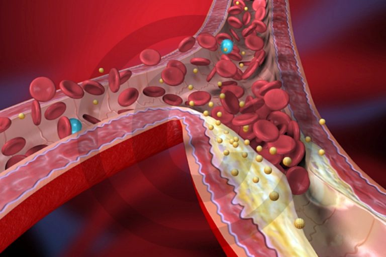 Dobry cholesterol HDL. Kiedy może być niekorzystny?